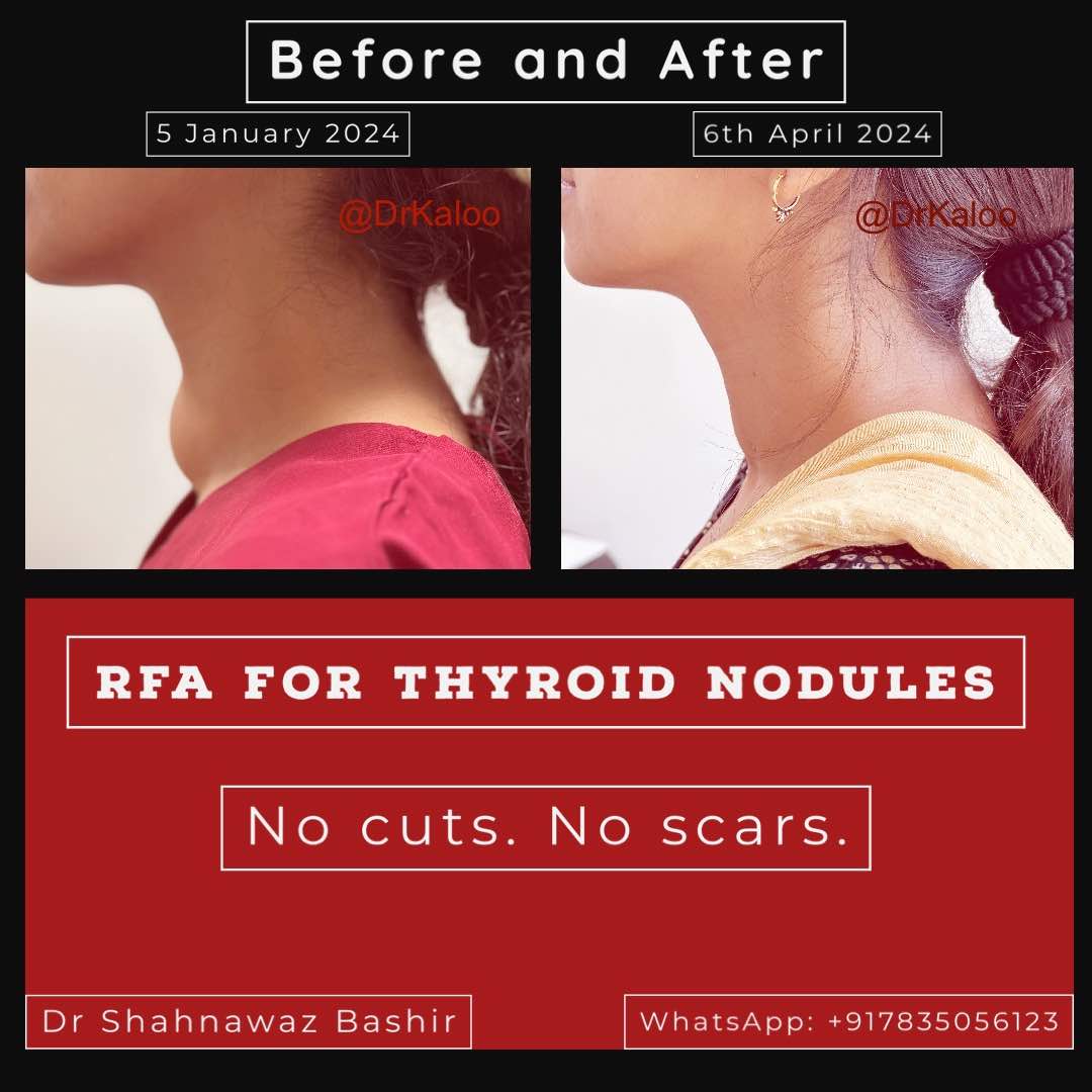 Before-After-RFA-Thyroid