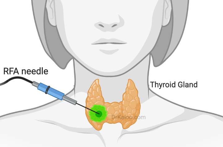 Thyroid_RFA_Radio_Frequency_Ablation_Delhi_India.jpg